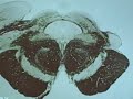 Midbrain (Level of Superior Colliculus)