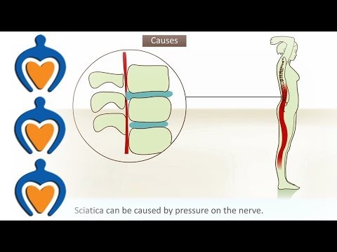 how to treat ischias