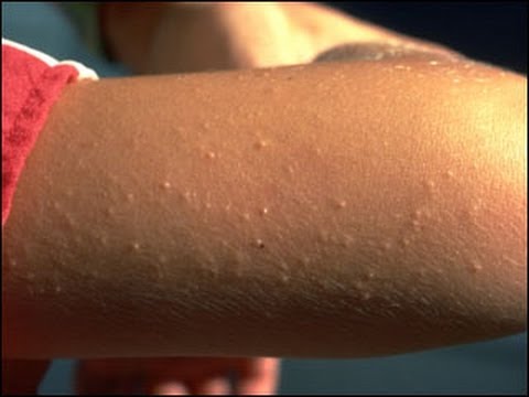 Get Rid of Chicken Skin: keratosis Pilaris