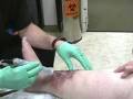 venous leg ulcer - phage clinical trial