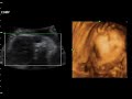 Dzaky Mom 6 Month Pregnant   4 Dimension UltraSonoGraphy 2 Ultrasonography