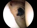Superior Labral Tear  Dr. Allan Mishra/Emedx.com