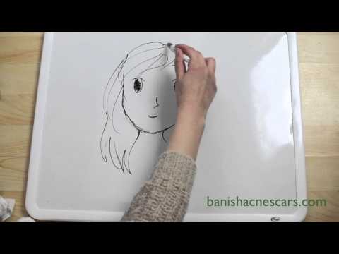 how to use aloe vera for acne scars