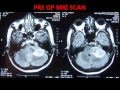 Brain tumor-posterior fossa meningiomas-treatment-images-dr suresh dugani/HUBLI/INDIA