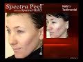 Spectra VRM Laser Treatment : Spectra Peel Testimonial