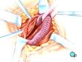 Malpractice Medical Hernia Repair Inguinal (Open) Surgery 2