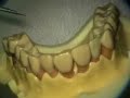 Perioscopy Explorer Positioning UL palatal, facial