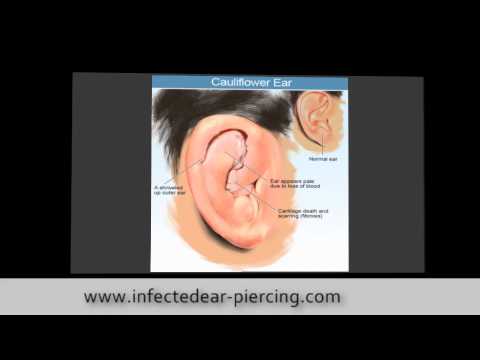 how to cure infected ear piercing