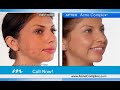 Murad Acne Complex Acne Treatment Kit