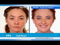 Murad Acne Complex Acne Treatment Kit