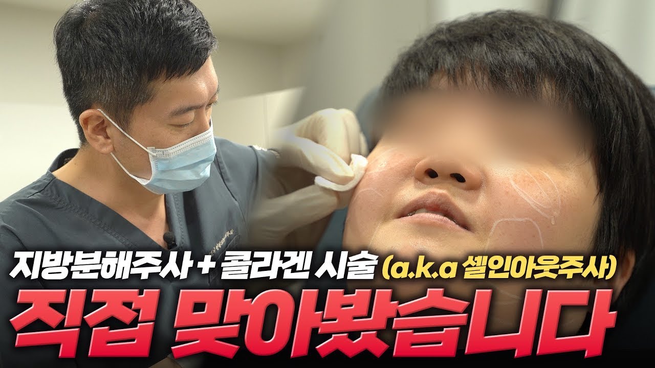 시술 후 바로 효과? 얼굴형을 바꾸는 셀인아웃주사 | 리얼 체험기