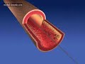 coronary artery stenting coronary artery stenting