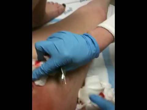 PERIANAL ABSCESS - Giant abbscess being surgically drained. The dr. refused for 7 days prior to draining this to do so claiming
