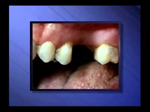 how to whiten partials