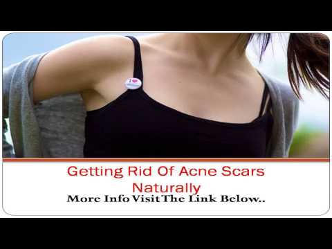 how to get rid of acne scars nz