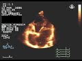 3D Tricuspid Atresia