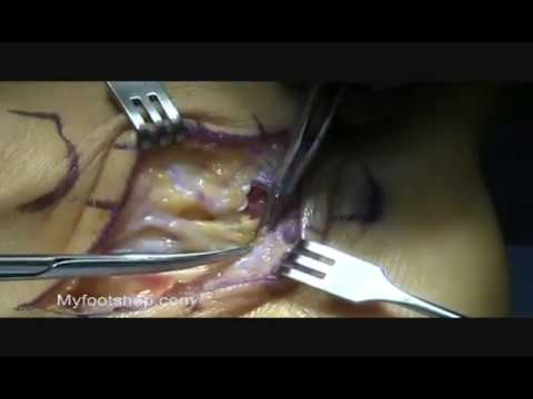 Tarsal Tunnel Surgery - Myfootshop.com