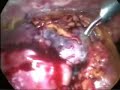 Diagnostic Laparoscopy