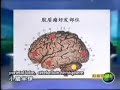 Local Immunotoerapy of Glioma - Part 1 Local Immunotoerapy of Glioma - Part 1