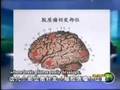 Local Immunotoerapy of Glioma - Part 1