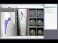 HipOp planning software (3)