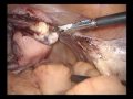 Cirugia Laparoscopica CIRUGIA NARRADA - Cirujano Oncologo Dr. Nery Rivadeneira, Guayaquil Ecuador