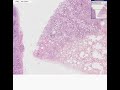 Histopathology Lung, lymph node --Bronchioloalveolar carcino