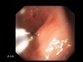 Duodenal Ulcer Clipping Duodenal Ulcer Clipping