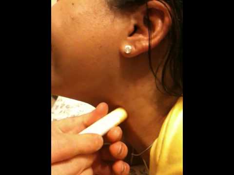 how to remove hickey
