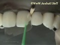 STEP 3 Class IV ADhesive