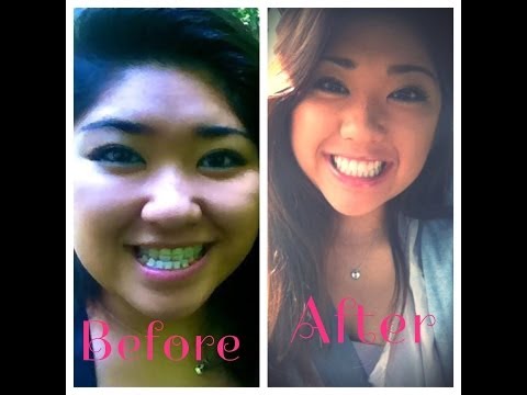 how to fix underbite