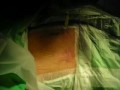 Operacion de Hernia Discal con Discolisis Operacion de Hernia Discal con Discolisis
