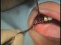 ExFeel Internal Live Surgery - 02