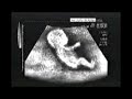 Mrs. Schumacher´s ultrasonography