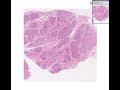Histopathology Breast Hyperplasia of pregnancy