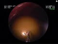 Intragastrik balon ekstraksiyonu Intragastrik balon ekstraksiyonu