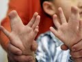 menino com 31 dedos - the boy with 31 fingers