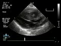 Asymmetric Septal Hypertrophy (ASH) in an Infant