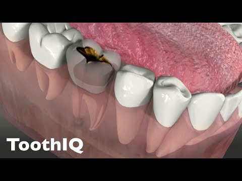 Cracked Tooth Crown Or Extraction Process