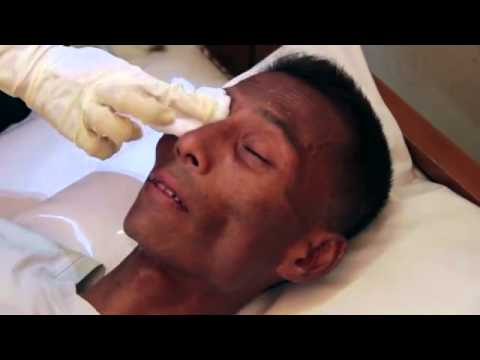 how to treat cmv virus