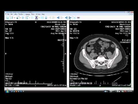 how to measure bleed in ct scan