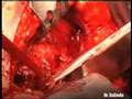 Fractura de Cotilo. Dr. Enrique G. Martens. Dr. G. Andujar
