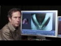 Laryngology 101 HD - Hemorrhagic vocal cord polyps, part I, HD version