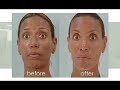 Dr. Mentz Botox Cosmetic - Mentz MediSpa Vignettes Dr. Mentz Botox Cosmetic - Mentz MediSpa Vignettes