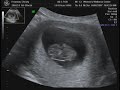 9 weeks 3 days - ultrasound