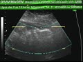 GRAVIMAGEM 870 (ULTRA-SOM 3D 4D GRAVIDEZ 27 SEMANAS)