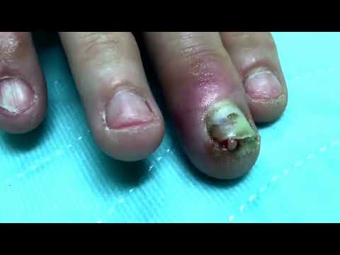 how to drain infected finger