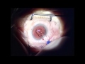 ReStor IntraOcular Lens Exchange for Staar NanoFlex Collamer Lens