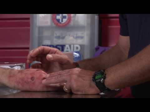 how to treat severe sunburn