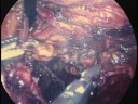 Laparoscopic Radical Hysterectomy-Nerve Sparing method Laparoscopic Radical Hysterectomy-Nerve Sparing method